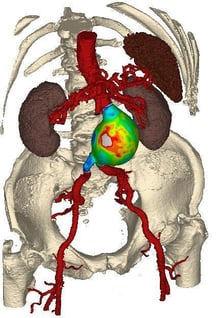 Cardiofem Example